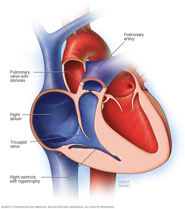 Pulmonary ass alabama