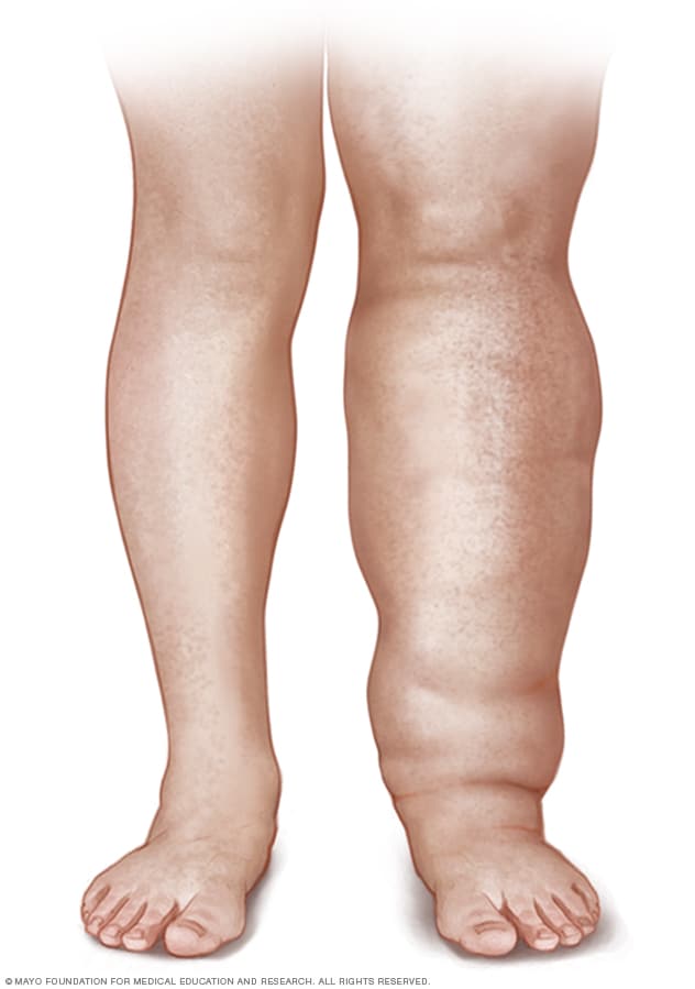 Illustration of a person with leg lymphedema