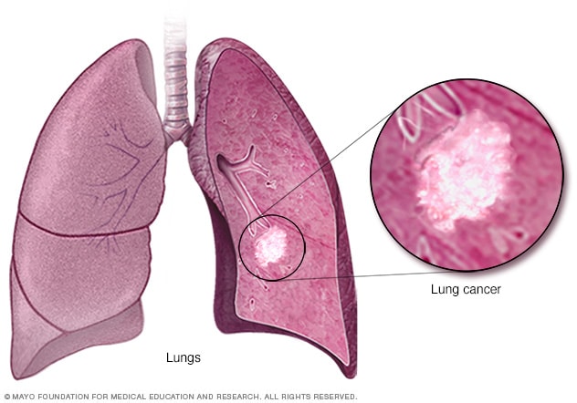 Cáncer de pulmón - Síntomas y causas - Mayo Clinic