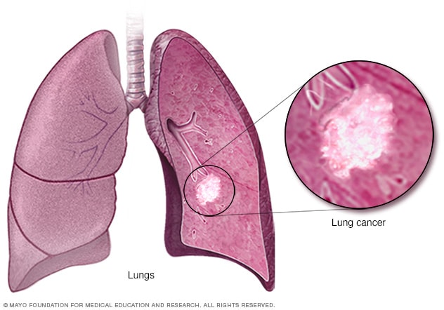 Cáncer de pulmón