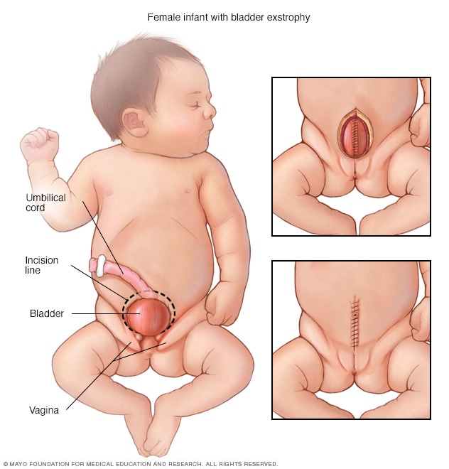 Extrofia vesical y reparación quirúrgica en un bebé de sexo femenino