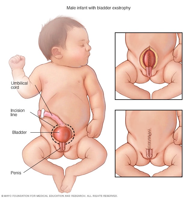 Extrofia vesical y reparación quirúrgica en un bebé de sexo masculino