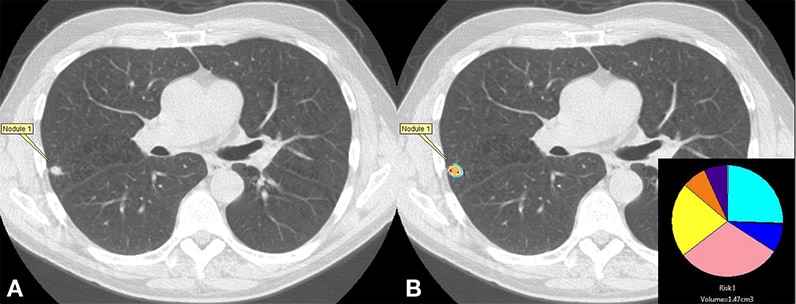 CT- and CANARY-analyzed pulmonary nodule