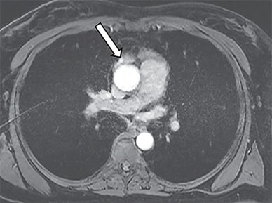 Arterial phase MRI of the chest