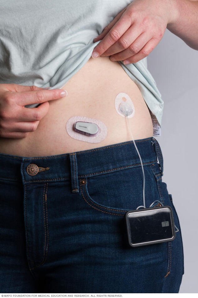 Blood Glucose Levels Chart Mayo Clinic