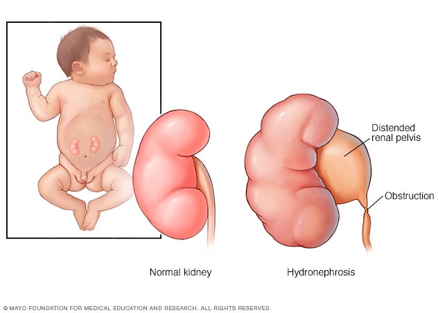 Un riñón normal y un riñón con hidronefrosis en un bebé