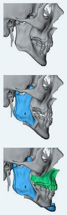 Pre-surgical virtual scanning with 3-D imaging