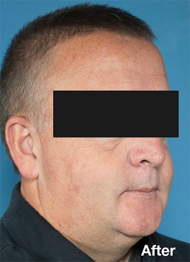 Appearance after maxillomandibular advancement surgery