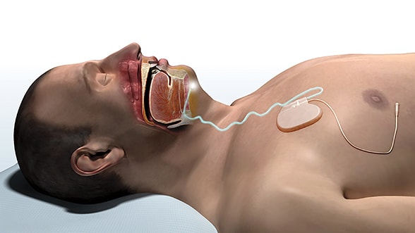 Inspire upper airway stimulation system