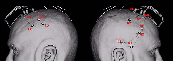 Positioning of electrodes for stereoelectroencephalography