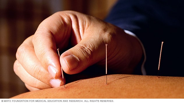 Fertility Acupuncture, London