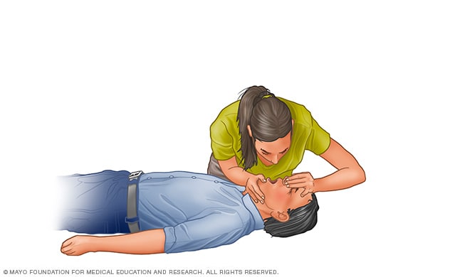 Cardiopulmonary resuscitation (CPR): First aid - Mayo Clinic