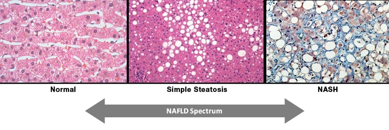 Gama de la esteatosis hepática no alcohólica