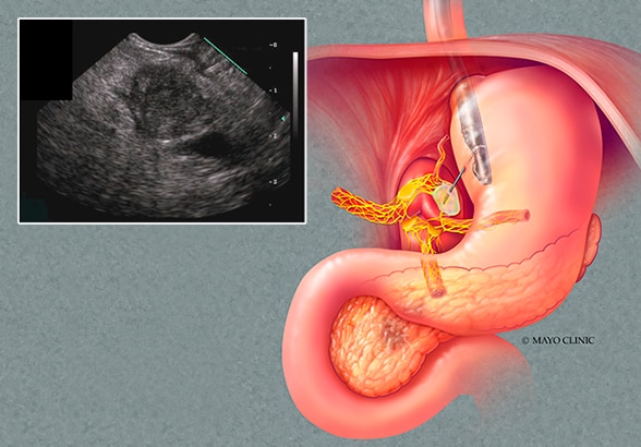 Pancreatic ductal adenocarcinoma