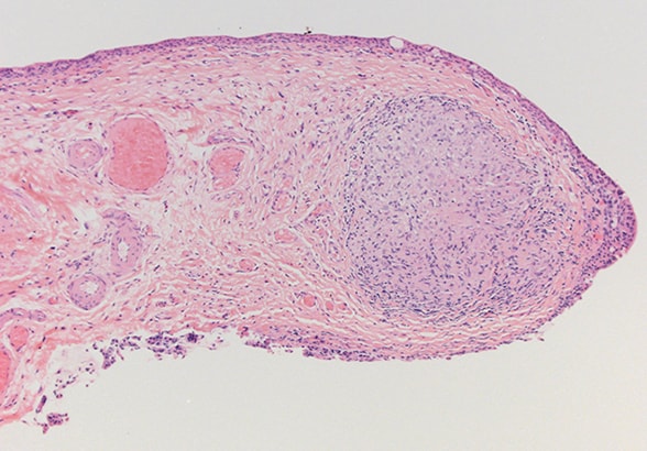 Nonnecrotizing epithelioid granuloma