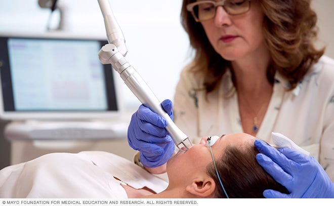 Un médico realiza un procedimiento de exfoliación facial por láser.