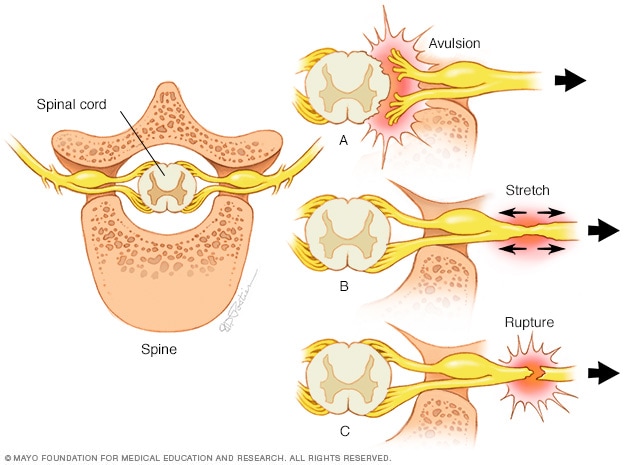 Tipos de lesiones nerviosas: avulsión, estiramiento y ruptura