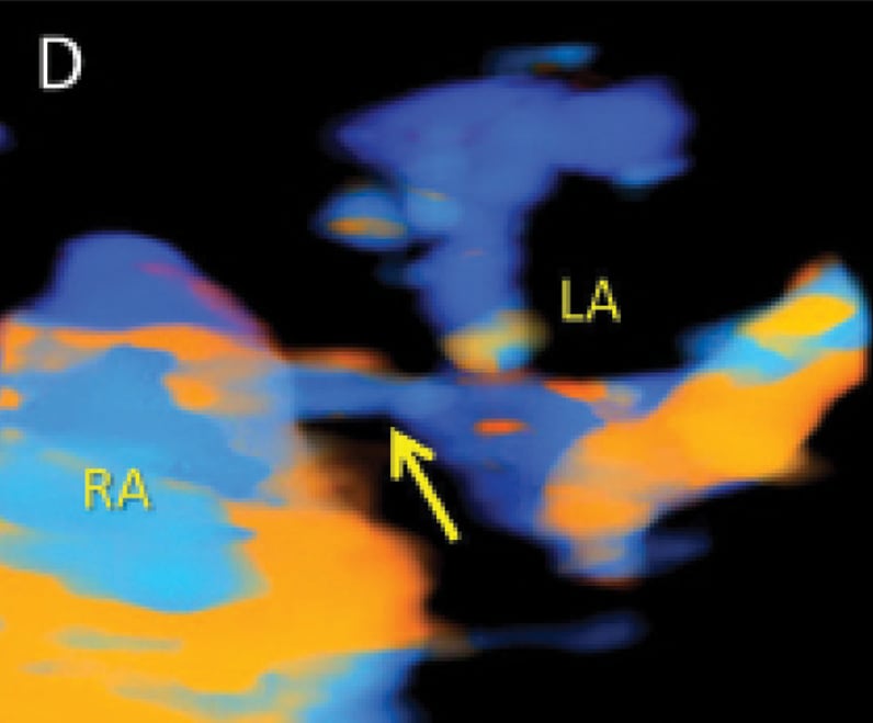 3-D power Doppler of atrial level shunt