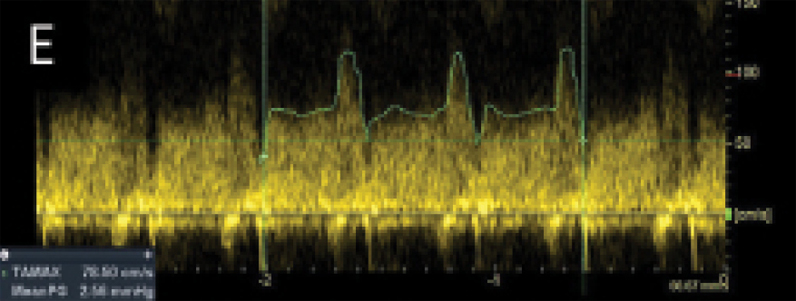 Interrogación Doppler de onda de pulso de la derivación auricular
