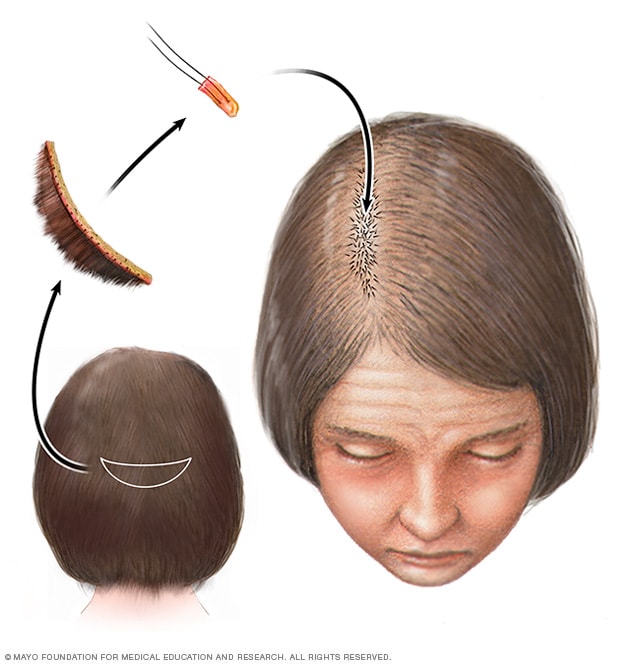 Caída cabello Diagnóstico y tratamiento - Mayo Clinic