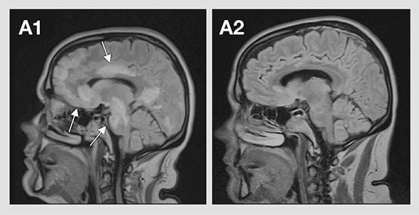 FLAIR image of adult patient demonstrates multifocal T2 hyperintense lesions