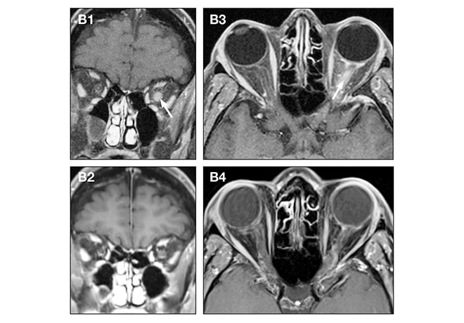 MRI scans show enhancement of the left optic nerve and nerve sheath