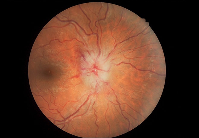 Significant papilledema in a young female diagnosed with Henoch-Schonlein purpura IgA vasculitis