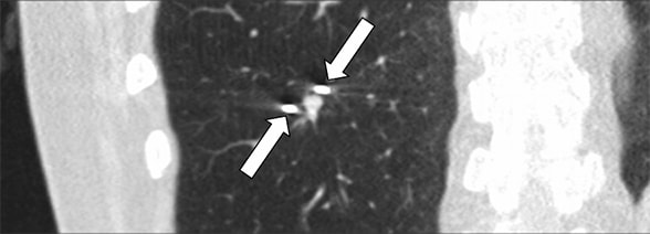 CT-guided cryoablation of lung nodule