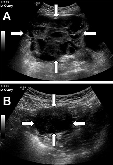 Preoperative and postoperative pelvic ultrasounds