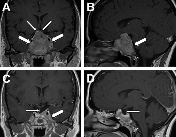 Head MRI scan