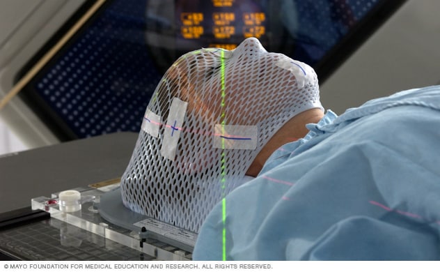 Face mask for LINAC stereotactic radiosurgery of the brain