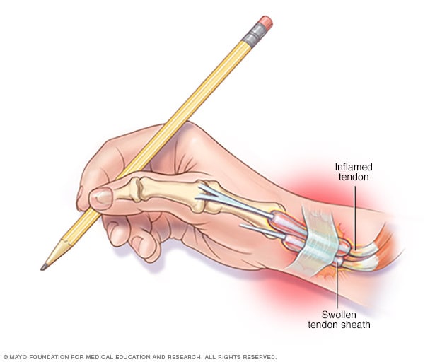 Illustration of tendon swelling caused by De Quervain tenosynovitis