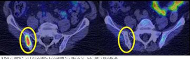 A tumor in the pelvic bone