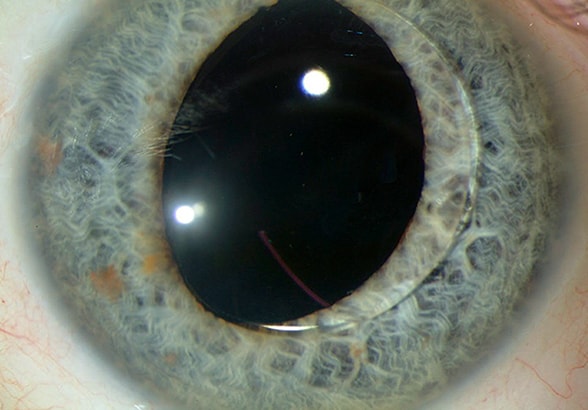 Case of spontaneous lens haptic disinsertion leading to lens dislocation