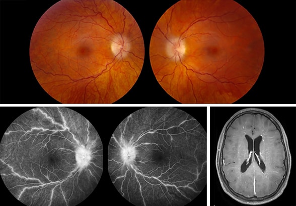 Fluorescein angiogram of selective involvement of the venules