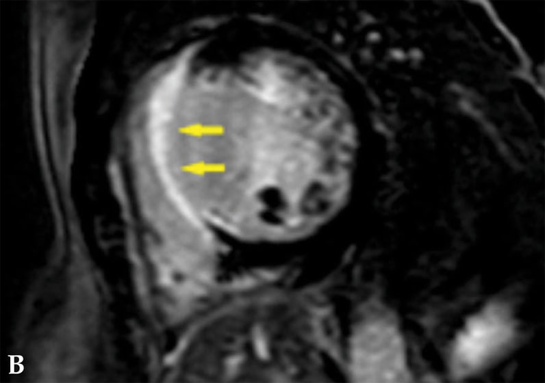 تصوير بالرنين المغناطيسي بعد التباين لمريض مصاب بساركويد القلب.