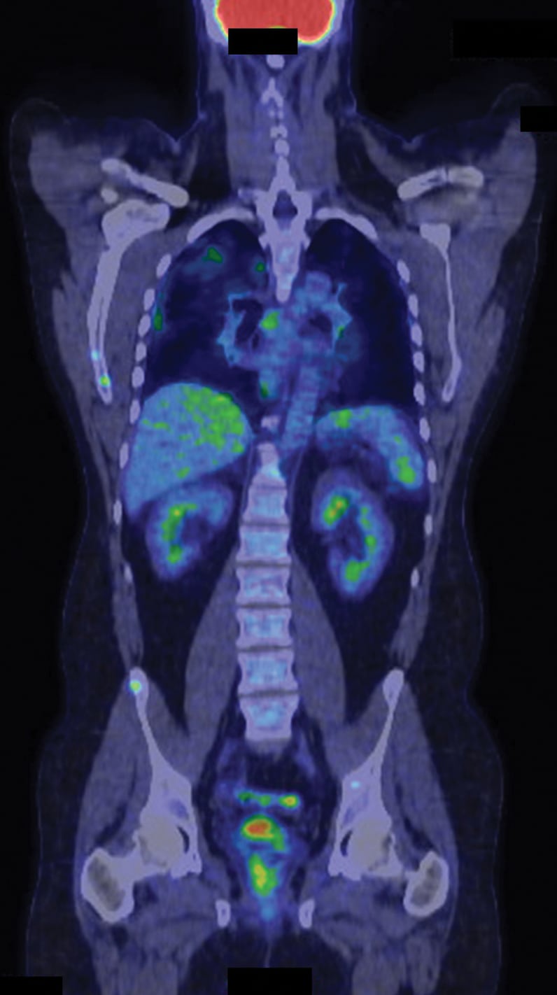 Multiple focal sites of increased FDG activity