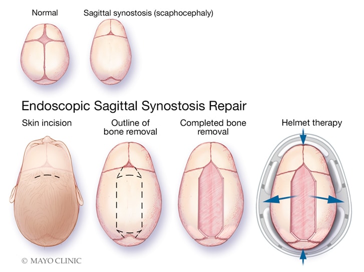  Surgical technique for single incision endoscope-assisted sagittal strip craniectomy