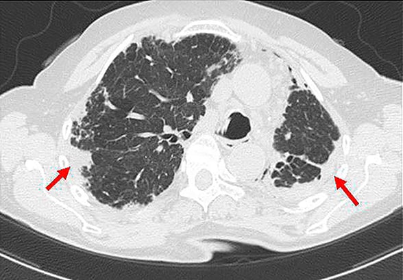 Suspected PPFE in female with progressive dyspnea and hypoxemia