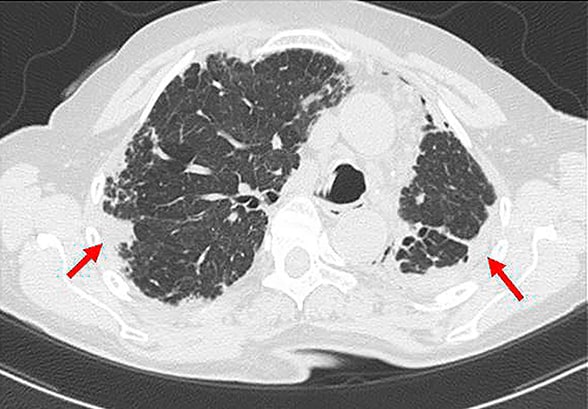 Suspected PPFE in female with progressive dyspnea and hypoxemia