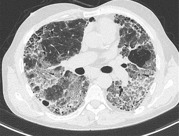 Acute exacerbation in male presenting with ILD fitting IPAF criteria