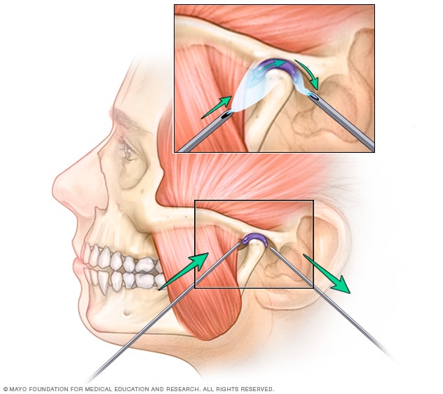 Trastornos de articulación temporomandibular - Diagnóstico y tratamiento -  Mayo Clinic