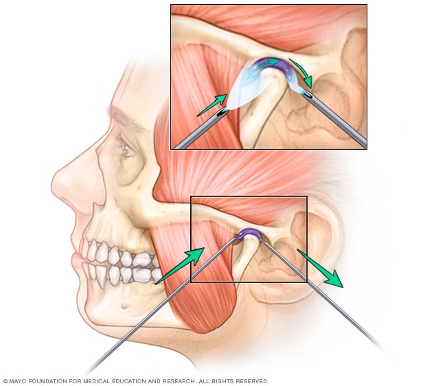 Tramadol Treatment For Tmj Pain Treatment