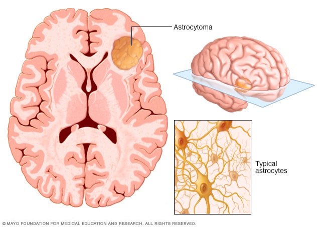 Un cerebro con un tumor cerebral de astrocitoma y astrocitos normales