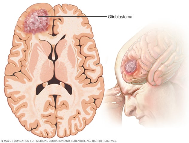 brain cancer cell