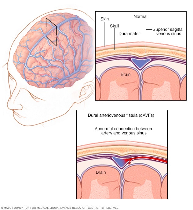 Dural Arteriovenous Fistulas Symptoms And Causes Mayo Clinic