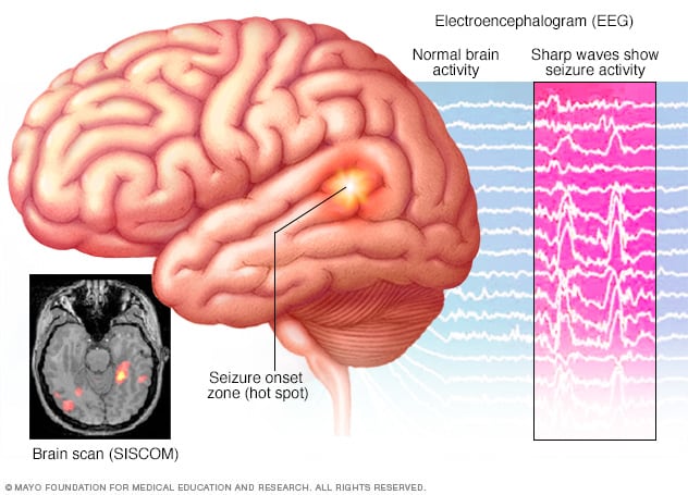 Electroencefalograma (EEG) que muestra actividad de convulsiones en el cerebro