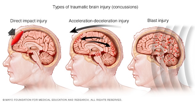 الأضرار في مناطق مختلفة من الدماغ بحسب نوع الإصابة