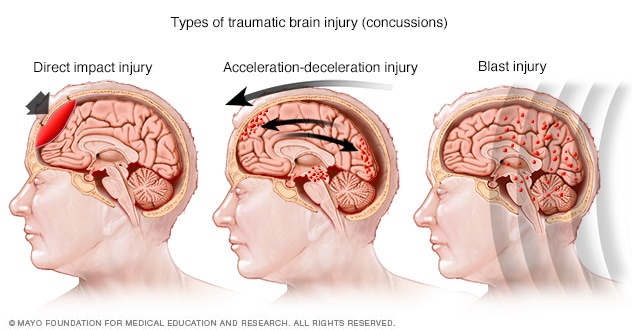 Damage in different areas of the brain based on injury type