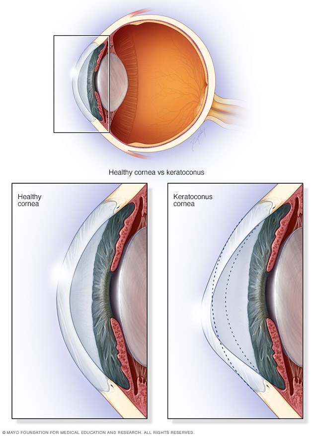 [Resim: keratoconus-8col-3080463-001-0.jpg]